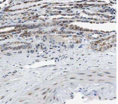 Immunohistochemistry-Paraffin: FAR2 Antibody [NBP1-90435] - Staining of human renal cancer shows moderate granular cytoplasmic positivity in tumor cells.
