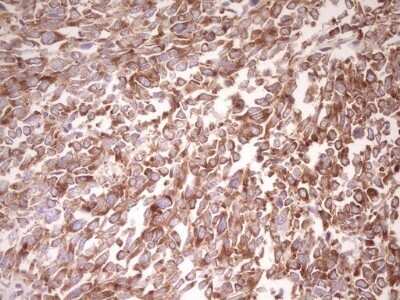 Immunohistochemistry: FARSB Antibody (OTI4B3) - Azide and BSA Free [NBP2-71539] - Analysis of Human melanoma tissue. (Heat-induced epitope retrieval by 1 mM EDTA in 10mM Tris, pH8.5, 120C for 3min)