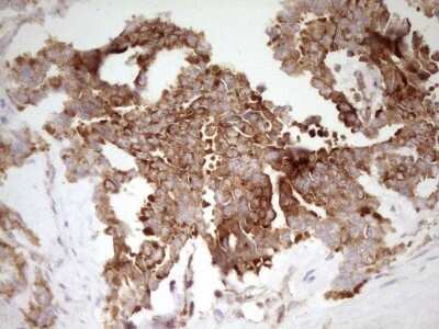 Immunohistochemistry: FARSB Antibody (OTI4B3) - Azide and BSA Free [NBP2-71539] - Analysis of Human testicular cancer tissue. (Heat-induced epitope retrieval by 1 mM EDTA in 10mM Tris, pH8.5, 120C for 3min)