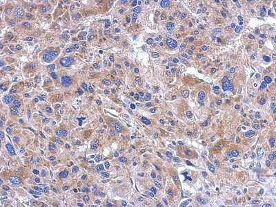 Immunohistochemistry-Paraffin: FASTKD5 Antibody [NBP2-16435] - Immunohistochemical analysis of paraffin-embedded Hepatoma, using antibody at 1:500 dilution.