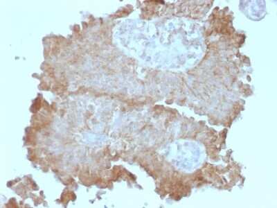 Immunohistochemistry-Paraffin: FAT2 Antibody (8C5) [NBP2-54371] - Formalin-fixed, paraffin-embedded Human Bladder Carcinoma stained with Protocadherin FAT2 Monoclonal Antibody (8C5).