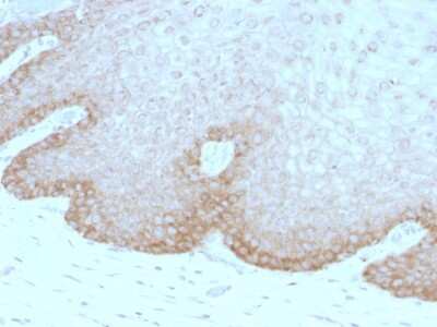 Immunohistochemistry-Paraffin: FAT2 Antibody (8C5) [NBP2-54371] - Formalin-fixed, paraffin-embedded Human Cervical Carcinoma stained with Protocadherin FAT2 Monoclonal Antibody (8C5).