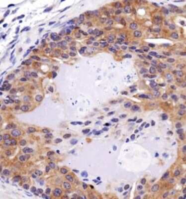 Immunohistochemistry: FAT4 Antibody [NBP1-78381] - IHC analysis of FAT4 in mouse prostate cancer using DAB with hematoxylin counterstain.