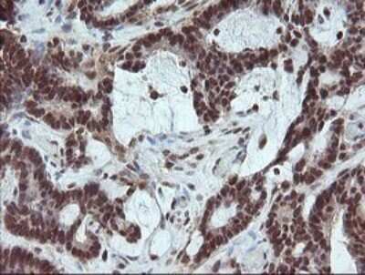 Immunohistochemistry: FATE1 Antibody (OTI1A1) [NBP2-45594] - Analysis of Adenocarcinoma of Human colon tissue.