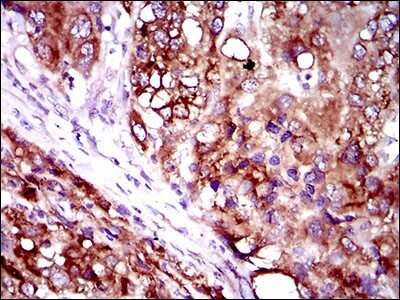 Immunohistochemistry-Paraffin: FATP2/SLC27A2 Antibody (6B3A9) [NBP2-37738] - Analysis of  liver cancer tissues using SLC27A2 mouse mAb with DAB staining.