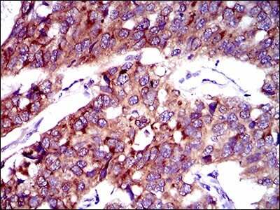 Immunohistochemistry-Paraffin: FATP2/SLC27A2 Antibody (6B3A9) [NBP2-37738] - Analysis of esophageal cancer tissues using SLC27A2 mouse mAb with DAB staining.