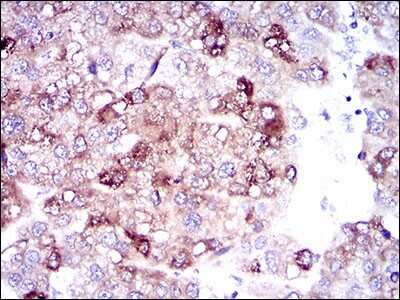 Immunohistochemistry: FATP5/SLC27A5 Antibody (4B11C10) [NBP2-37413] - Immunohistochemical analysis of paraffin-embedded liver cancer tissues using SLC27A5 mouse mAb with DAB staining.