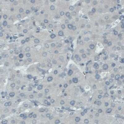 Immunohistochemistry-Paraffin: FATP5/SLC27A5 Antibody (CL0215) [NBP2-52880] - Staining of human liver cancer shows absence of immunoreactivity in tumor cells.