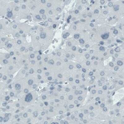 Immunohistochemistry-Paraffin: FATP5/SLC27A5 Antibody (CL0216) [NBP2-52881] - Staining of human liver cancer shows absence of immunoreactivity in tumor cells.