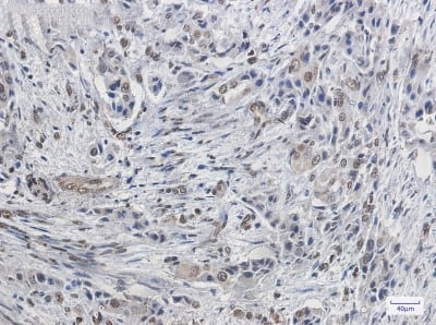 Immunohistochemistry-Paraffin: FBPase 1 Antibody (S04-1D6) [NBP3-19953] - Immunohistochemistry of FBPase 1 in paraffin-embedded Human lung cancer tissue using NBP3-19953 at dilution 1/20