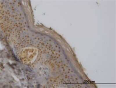 Immunohistochemistry-Paraffin: FBXO11 Antibody (4C12) [H00080204-M01] - Analysis of monoclonal antibody to FBXO11 on formalin-fixed paraffin-embedded human melanoma. Antibody concentration 3 ug/ml.