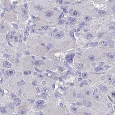 Immunohistochemistry: FBXO47 Antibody [NBP2-31679] - Staining of liver cancer.