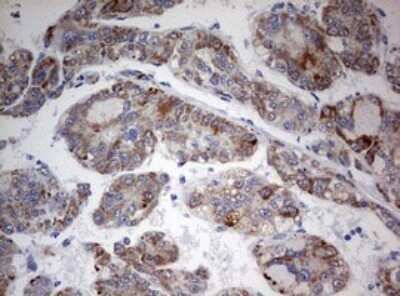 Immunohistochemistry: FEN-1 Antibody (OTI1F3) - Azide and BSA Free [NBP2-70716] - Analysis of Carcinoma of Human liver tissue.(Heat-induced epitope retrieval by 10mM citric buffer, pH6.0, 120C for 3min)