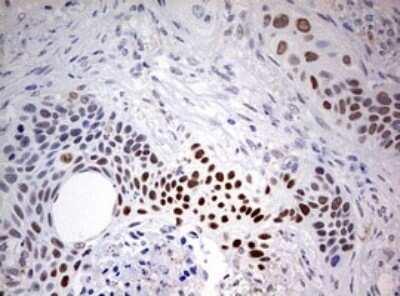 Immunohistochemistry: FEN-1 Antibody (OTI1F3) - Azide and BSA Free [NBP2-70716] - Analysis of Carcinoma of Human lung tissue. (Heat-induced epitope retrieval by 10mM citric buffer, pH6.0, 120C for 3min)