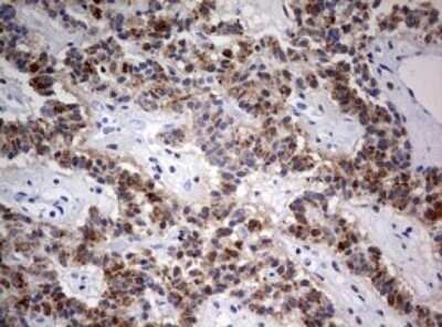 Immunohistochemistry: FEN-1 Antibody (OTI1F3) - Azide and BSA Free [NBP2-70716] - Analysis of Carcinoma of Human pancreas tissue. (Heat-induced epitope retrieval by 10mM citric buffer, pH6.0, 120C for 3min)