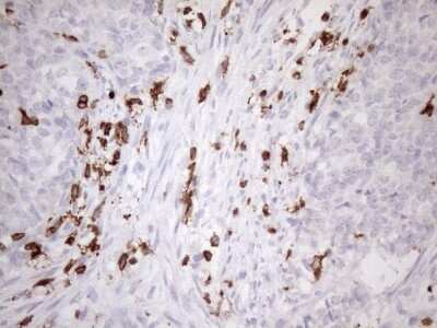 Immunohistochemistry: FERMT3/URP2 Antibody (3C7) [NBP2-45641] - Analysis of Adenocarcinoma of Human endometrium tissue. (Heat-induced epitope retrieval by 1mM EDTA in 10mM Tris buffer (pH8.5) at 120C for 3 min)