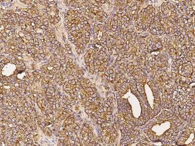 Immunohistochemistry-Paraffin: FGF-10 Antibody [NBP2-98997] - Staining of human FGF-10 in human prostatic carcinoma with rabbit polyclonal antibody (1:1000).