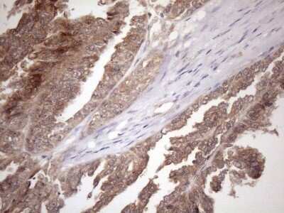 Immunohistochemistry: FGF-13 Antibody (OTI7E8) - Azide and BSA Free [NBP2-70721] - Analysis of Adenocarcinoma of Human ovary tissue. (Heat-induced epitope retrieval by 1mM EDTA in 10mM Tris buffer (pH8.5) at 120C for 3 min)