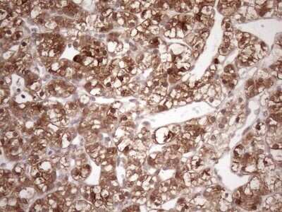 Immunohistochemistry: FGF-13 Antibody (OTI7E8) - Azide and BSA Free [NBP2-70721] - Analysis of Carcinoma of Human kidney tissue. (Heat-induced epitope retrieval by 1mM EDTA in 10mM Tris buffer (pH8.5) at 120C for 3 min)