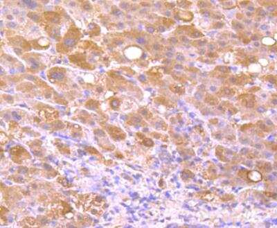 Immunohistochemistry-Paraffin: FGF-21 Antibody (AH21-71) [NBP2-67275] - Analysis of paraffin-embedded human liver cancer tissue using anti-FGF21 antibody. Counter stained with hematoxylin.