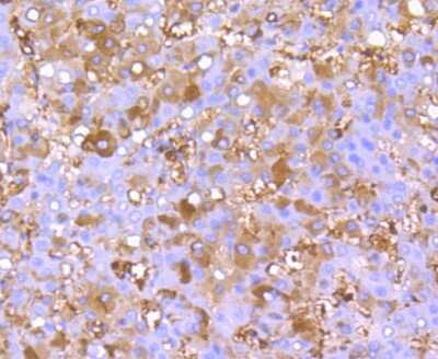Immunohistochemistry-Paraffin: FGF-21 Antibody (JA10-97) [NBP2-66841] - Analysis of paraffin-embedded human liver cancer tissue using anti-FGF21 antibody. Counter stained with hematoxylin.