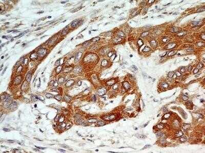 Immunohistochemistry-Paraffin: FGFR1 Antibody (M17D10) - Azide and BSA Free [NBP2-80733] - IHC analysis of formalin-fixed paraffin-embedded tissue section of human esophageal squamous cell carcinoma (SCC) using mouse monoclonal FGF R1 antibody (clone M17D10) at 5 ug/ml concentration. Specific membrane-cytoplasmic immunopositivity of FGF R1 prot