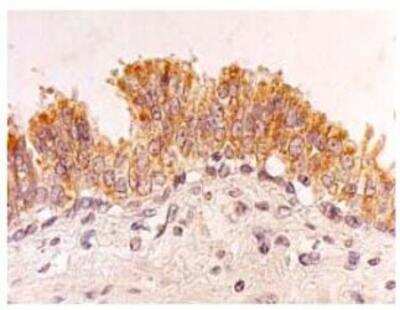 Immunohistochemistry-Paraffin: FHL2 Antibody (11-134) [NBP1-54577] - Immunohistochemical detection of FHL2 on paraffin embedded section of a human prostate cancer with FHL2 Antibody (11-134).
