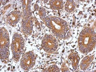 Immunohistochemistry-Paraffin: FHL2 Antibody [NBP1-31262] - Paraffin-embedded Colon ca, using antibody at 1:500 dilution.