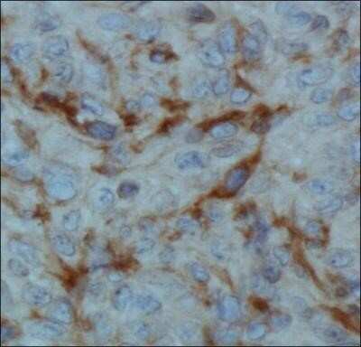 Immunohistochemistry: FIH-1/HIF-1AN Antibody (162c) - Azide and BSA Free [NBP2-80738] - Analysis of FIH in human renal cancer using DAB with hematoxylin counterstain. Image from the standard format of this antibody.