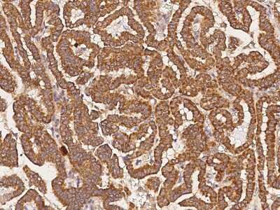Immunohistochemistry-Paraffin: FIH-1/HIF-1AN Antibody [NBP2-98999] - Immunochemical staining of human FIH-1/HIF-1AN in human thyroid carcinoma with rabbit polyclonal antibody (1:300, formalin-fixed paraffin embedded sections).