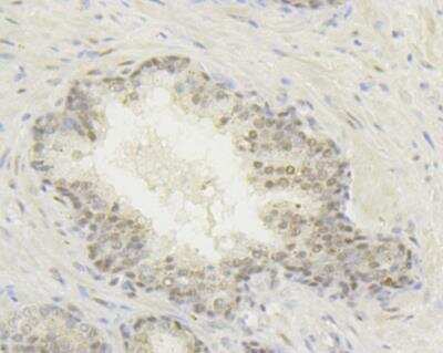 Immunohistochemistry: FIH-1/HIF-1AN Antibody (JG37-66) [NBP2-76841] - Immunohistochemical analysis of paraffin-embedded human prostate cancer tissue using anti-HIF1AN antibody. Counter stained with hematoxylin.