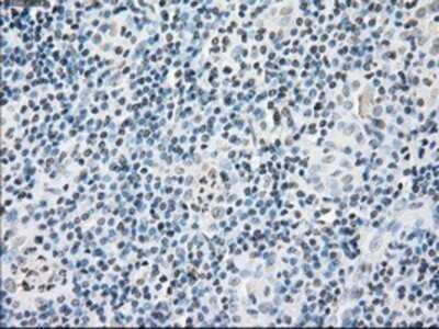 Immunohistochemistry: FKBP51/FKBP5 Antibody (OTI3E9) - Azide and BSA Free [NBP2-70742] - Staining of paraffin-embedded Carcinoma of thyroid tissue using anti-FKBP5/FKBP51 mouse monoclonal antibody.