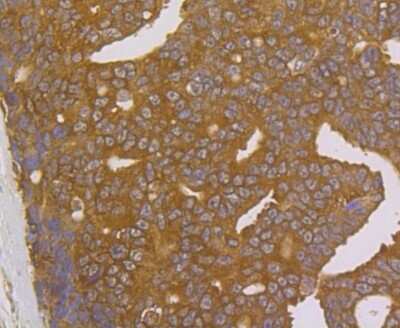 Immunohistochemistry-Paraffin: FKBP52/FKBP4 Antibody (JG96-30) [NBP2-75491] - Analysis of paraffin-embedded human prostate cancer tissue using anti-FKBP52 antibody. Counter stained with hematoxylin.