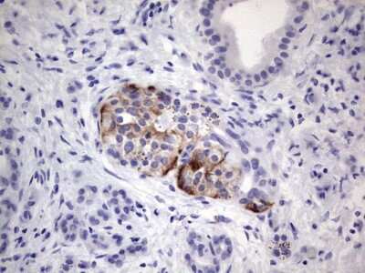 Immunohistochemistry: FLJ23356 Antibody (2B10) [NBP2-45805] - Analysis of Carcinoma of Human pancreas tissue.