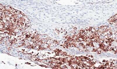 Immunohistochemistry-Paraffin: FLRT1 Antibody [NBP1-31403] - Paraffin-embedded OVCA, using antibody at 1:100 dilution.
