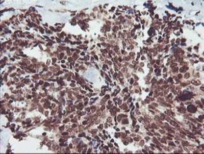 Immunohistochemistry: FMRP Antibody (OTI1C6) - Azide and BSA Free [NBP2-70756] - Staining of paraffin-embedded Adenocarcinoma of Human breast tissue using anti-FMRP mouse monoclonal antibody.