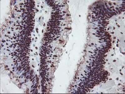 Immunohistochemistry: FMRP Antibody (OTI1C6) - Azide and BSA Free [NBP2-70756] - Staining of paraffin-embedded Adenocarcinoma of Human colon tissue using anti-FMRP mouse monoclonal antibody.