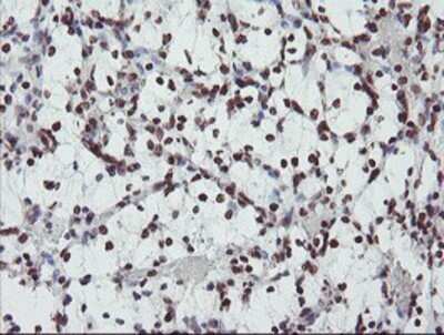 Immunohistochemistry: FMRP Antibody (OTI1C6) - Azide and BSA Free [NBP2-70756] - Staining of paraffin-embedded Carcinoma of Human kidney tissue using anti-FMRP mouse monoclonal antibody.