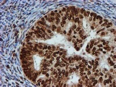 Immunohistochemistry: FMRP Antibody (OTI3B4) - Azide and BSA Free [NBP2-70761] - Analysis of Adenocarcinoma of Human endometrium tissue.