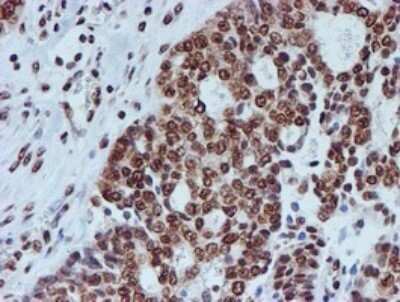 Immunohistochemistry: FMRP Antibody (OTI3B4) - Azide and BSA Free [NBP2-70761] - Analysis of Adenocarcinoma of Human ovary tissue.