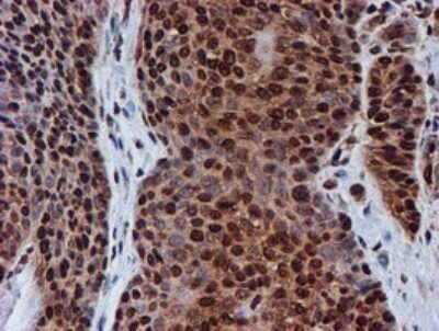 Immunohistochemistry: FMRP Antibody (OTI3B4) - Azide and BSA Free [NBP2-70761] - Analysis of Carcinoma of Human bladder tissue.