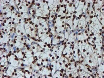 Immunohistochemistry: FMRP Antibody (OTI3B4) - Azide and BSA Free [NBP2-70761] - Analysis of Carcinoma of Human kidney tissue.