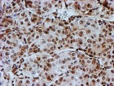 Immunohistochemistry: FMRP Antibody (OTI3B4) - Azide and BSA Free [NBP2-70761] - Analysis of Carcinoma of Human liver tissue.