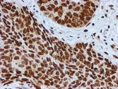 Immunohistochemistry: FMRP Antibody (OTI3B4) - Azide and BSA Free [NBP2-70761] - Analysis of Carcinoma of Human lung tissue.