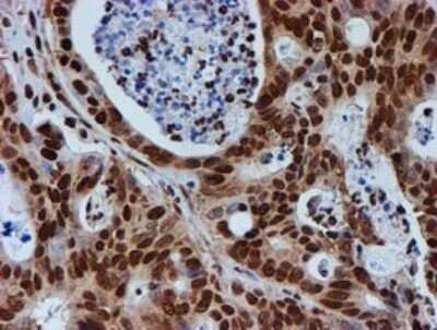 Immunohistochemistry: FMRP Antibody (OTI3B4) - Azide and BSA Free [NBP2-70761] - Analysis of Carcinoma of Human pancreas tissue.