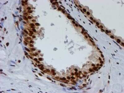 Immunohistochemistry: FMRP Antibody (OTI3B4) - Azide and BSA Free [NBP2-70761] - Analysis of Carcinoma of Human prostate tissue.