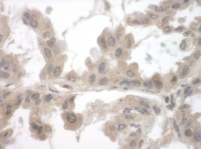 <b>Independent Antibodies Validation and Biological Strategies Validation.</b>Immunohistochemistry-Paraffin: FNBP1L Antibody [NBP1-80569] - Section of human lung carcinoma. Antibody: Affinity purified rabbit anti-Toca-1used at a dilution of 1:1,000 (1ug/ml) Detection: DAB