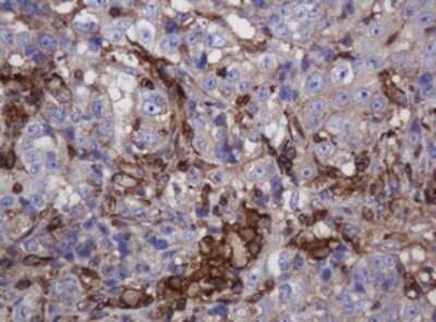 Immunohistochemistry: FNDC4 Antibody (OTI1B7) - Azide and BSA Free [NBP2-72151] - Analysis of Adenocarcinoma of Human colon tissue. (Heat-induced epitope retrieval by 10mM citric buffer, pH6.0, 120C for 3min)