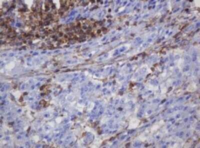 Immunohistochemistry: FNDC4 Antibody (OTI1B7) - Azide and BSA Free [NBP2-72151] - Analysis of Carcinoma of Human liver tissue.(Heat-induced epitope retrieval by 10mM citric buffer, pH6.0, 120C for 3min)