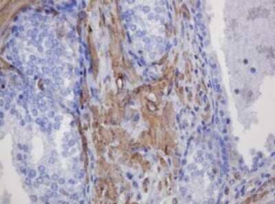 Immunohistochemistry: FNDC4 Antibody (OTI1B7) - Azide and BSA Free [NBP2-72151] - Analysis of Carcinoma of Human prostate tissue. (Heat-induced epitope retrieval by 10mM citric buffer, pH6.0, 120C for 3min)